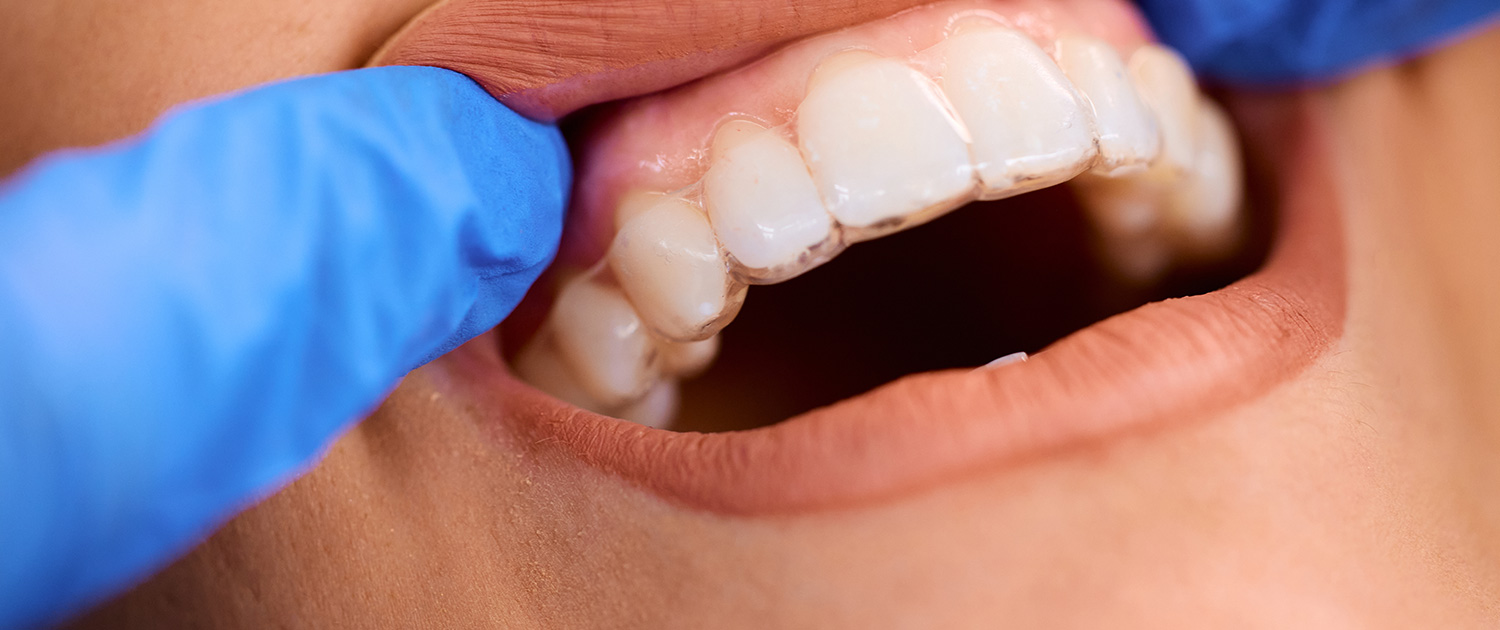 Orthodontics / Invisalign®